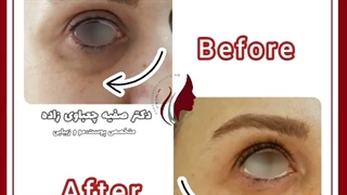 فیلم رفع گودی زیر چشم با تزریق ژل