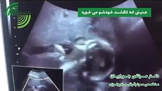 فیلم واقعی از جنینی که انگشت خودشو میخوره