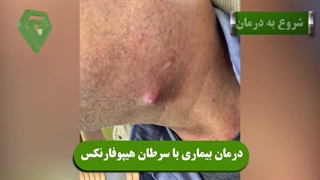 درمان بیماری سرطان هیپوفارنکس