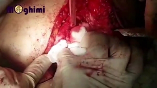 فیلم بدون سانسور از شکستگی فمور و پروتزگذاری مفصل ران