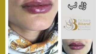 تزریق ۱ سی سی ژل لب