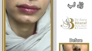 تزریق 1 سی سی ژل لب