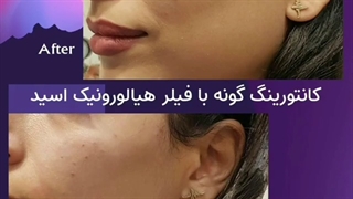 کانتورینگ گونه با فیلر هیالورونیک اسید