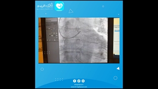 آنژیوپلاستی در بیماری با سابقه آنژیوگرافی و توصیه به عمل قلب باز در مرکز دیگر