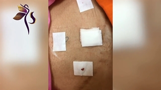 جراحی رحم به روش لاپاروسکوپی
