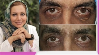 از بیماری زانتولاسما چه میدانید؟؟