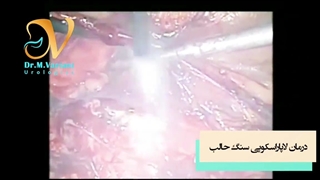 درمان لاپاراسکوپی سنگ حالب