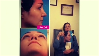 رضایت بیمار بعد از جراحی زیبایی بینی