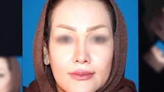 نمونه فیلم قبل و بعد از جراحی بینی گوشتی