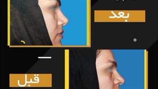 فیلم جراحی بینی گوشتی