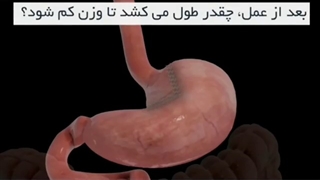 پاسخ به سوالات شما درباره جراحی بای پس معده