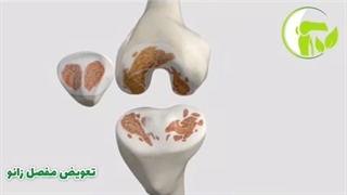 انیمیشن جالب تعویض مفصل زانو