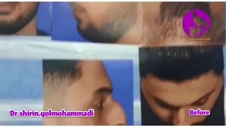 فیلم جراحی زیبایی بینی