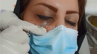 مزوتراپی زیر چشم