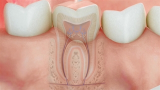 عصب کشی دندان
