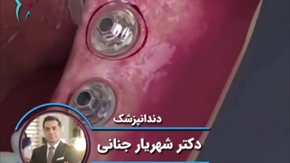 درمان لق شدن دندان و ایمپلنت