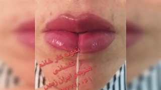 آموزش ژل و بوتاکس آنزیم