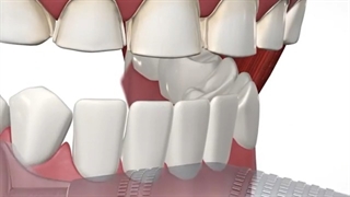 مراحل درمان لمینت سرامیکی | کلینیک تخصصی دندانپزشکی کانسپتا