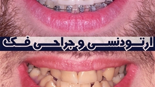 قبل و بعد ارتودنسی جلو بودن فک پایین | دکتر داودیان