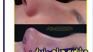 عمل زیبایی بینی در مشهد