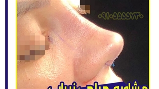 جراحی زیبایی بینی در مشهد