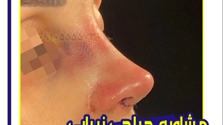 عمل جراحی زیبایی بینی در مشهد