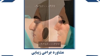 جراحی زیبایی عمل بینی در مشهد