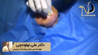 فیلم واقعی لیپوساکشن غبغب