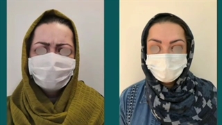قبل و بعد تزریق بوتاکس خط اخم و پیشانی