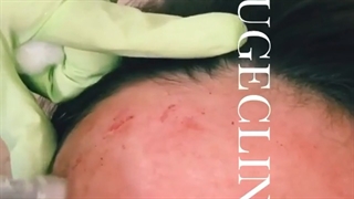 میکرونیدلینگ لیزر مو