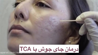 درمان جای جوش با tca کلینیک مو
