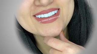 کامپوزیت دندان