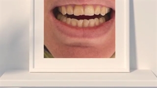 فیلم کامپوزیت دندان