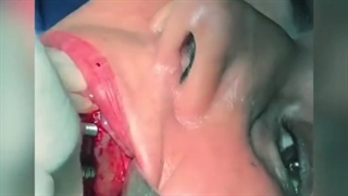 فیلم واقعی کاشت ایمپلنت دندان