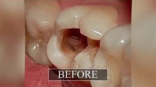 فیلم ترمیم دندان