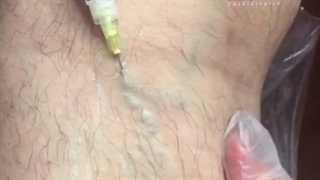 فیلم بدون سانسور اسکلروتراپی عروق واریسی پشت زانو در یک مرد جوان