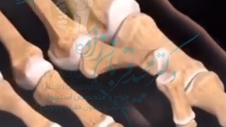 موضوع : عمل انگشت پا