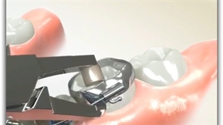 برداشتن براکت ارتودنسی | دکتر سعید قریشی