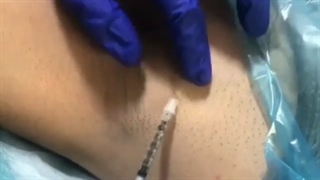 فیلم درمان تعریق زیربغل با تزریق بوتاکس