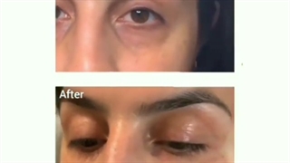 فیلم تزریق فیلر زیر چشم