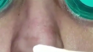 فیلم جراحی بینی خانم جوان