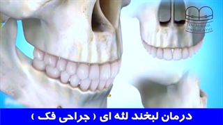 درمان لبخند لثه ای (جراحی فک) | دکتر احسان مهریزی