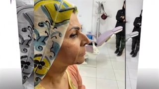 انجام اندولیفت با بیحسی موضعی