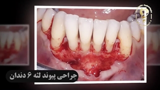 فیلم واقعی از جدیدترین روش جراحی پیوند لثه 6 دندان