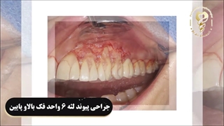 فیلم واقعی جراحی پیوند لثه بدون درد