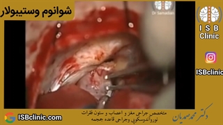 شوانوم وستیبولار