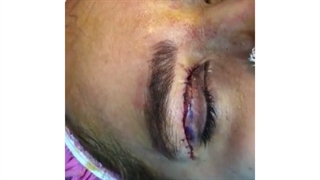 جراحی پلک بالا و لیفت گوشه چشم