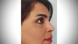 جراحی بینی بسیار پرچالش - بینی با انحراف شدید