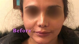 تخلیه ژل و تزریق چربی بعد از آن منافذ باز پوست
