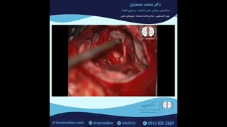 عمل جراحی شوانوم CPA